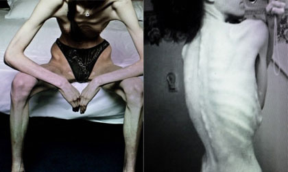 "Kinh hãi" trước cơ thể gầy đét của bệnh nhân mắc chứng biếng ăn