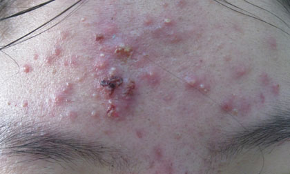 Mỹ phẩm "siêu trắng" và nguy cơ rậm lông, loạn sắc tố da