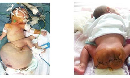 Cắt khối u quái nặng 2,6 kg cho trẻ sơ sinh 