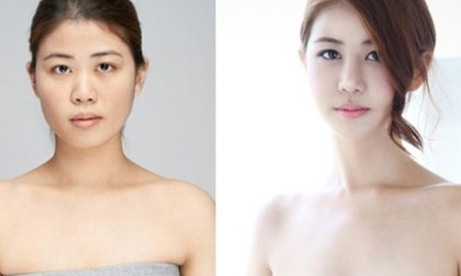 Cô gái Hàn thành hot girl sau khi phẫu thuật mặt và bộ ngực chảy xệ 23cm