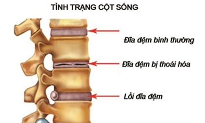 Bệnh gai cột sống và biến chứng