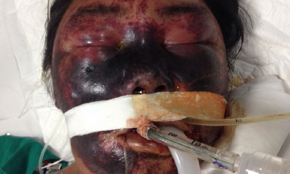 Hà Nội: Thêm 2 người tử vong, 1 người nguy kịch do ăn tiết canh lợn