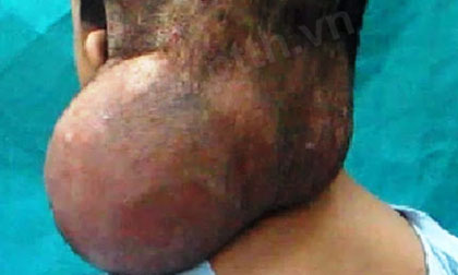 Cắt khối u khổng lồ cho người 'hai đầu'