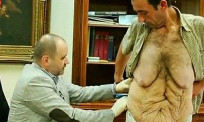 Ngắm da bụng chảy xệ khủng khiếp sau khi giảm 135kg