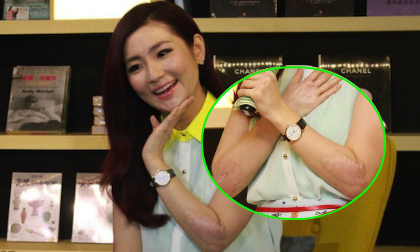 Selina vẫn lộ sẹo rõ rệt sau thời gian dài chạy chữa