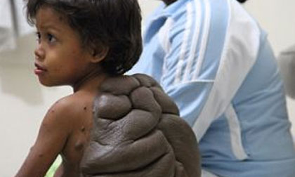 Cậu bé có nốt ruồi to như mai rùa trên lưng đã được phẫu thuật