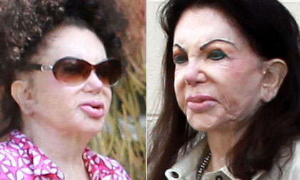 "Thảm họa thẩm mỹ" 92 tuổi lộ gương mặt chảy xệ biến dạng