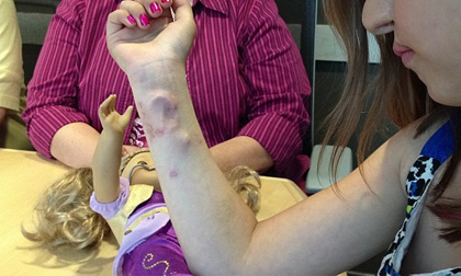 Bé gái có tai "mọc" ở cánh tay