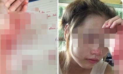 Nhớ người yêu, nữ sinh Hải Phòng tự rạch tay hành hạ bản thân