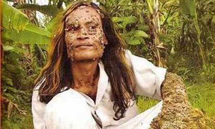 Kinh hoàng với căn bệnh kỳ lạ nhất trên thế giới