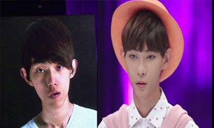 Chàng trai Hàn Quốc thành mỹ nam sau quá trình phẫu thuật thẩm mỹ