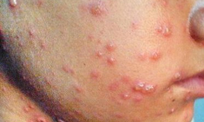 5 dấu hiệu dễ nhận biết của bệnh ung thư da