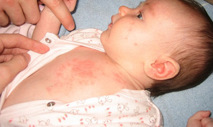 Hạn chế tình trạng rôm sảy của trẻ như thế nào?