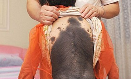 Bé gái được mệnh danh là "Miêu nữ" vì làn da mọc kín lông đen