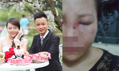 Lộ ảnh mặt sưng tím của cô gái bị chồng chưa cưới đánh và khoe trên Facebook