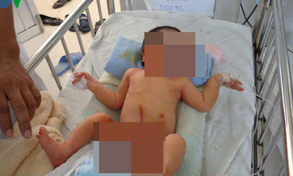 Bé gái bị bỏ rơi ở bụi tre, kiến cắn đỏ khắp người