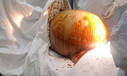 Thầy lang "phán" có thai, mổ ra khối u và dịch nặng 23 kg