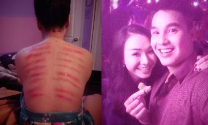 Vợ Baggio khoe tấm lưng kinh dị do chồng cạo gió