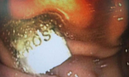 Rùng mình nghe bác sĩ kể chuyện gắp dao lam từ thực quản 