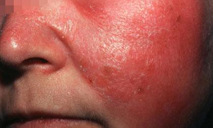 Mỡ người có thể chống lại nhiễm trùng và nhiễm độc máu