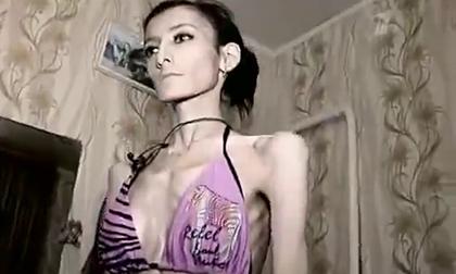 Choáng với thiếu nữ 23 tuổi nặng... 21 kg