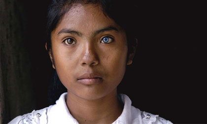 Cô gái có đôi mắt hai màu kỳ lạ ở Ninh Thuận