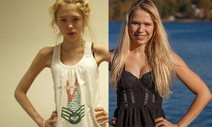 Cô gái 19 tuổi chiến đấu với bệnh biếng ăn nhờ ngũ cốc