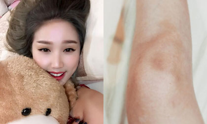 Bảo Thy kiêng vận động mạnh vì bị chấn thương đầu gối