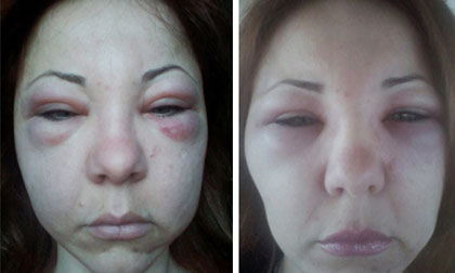 Nữ luật sư mặt sưng như quả bóng sau khi tiêm căng da