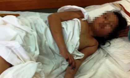 Nữ sinh bị hoại tử tứ chi từ vết xước nhỏ