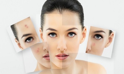 Những cách đơn giản chữa mụn tại nhà