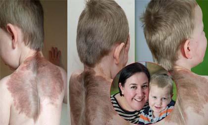 Cậu bé có vết bớt trên lưng như đôi cánh thiên thần