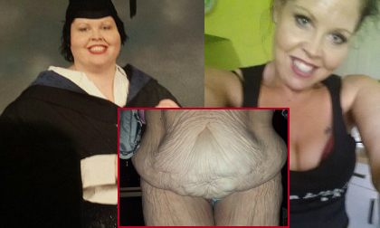 Bà mẹ giảm 75kg khiến da bụng nhăn nheo như quả bóng xì hơi