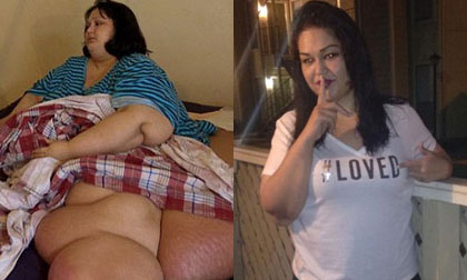 Cô gái 453kg giảm béo nhờ 11 ca phẫu thuật 