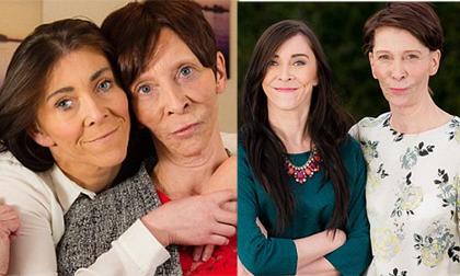 Hai mẹ con mắc bệnh lão hóa sớm 'lột xác' ngoạn mục