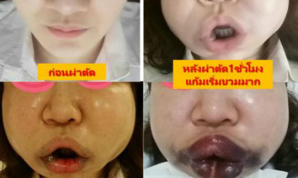 Cô gái thẩm mỹ khiến mặt sưng vù biến dạng 
