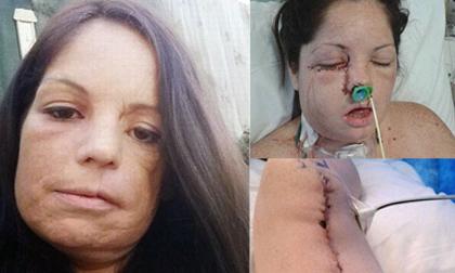 Khuôn mặt biến dạng như quái vật sau phẫu thuật ung thư miệng