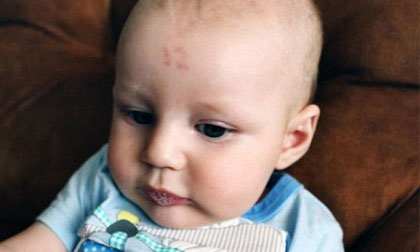 Nam Phi: Em bé sinh ra với vết bớt hình số 12 trên trán