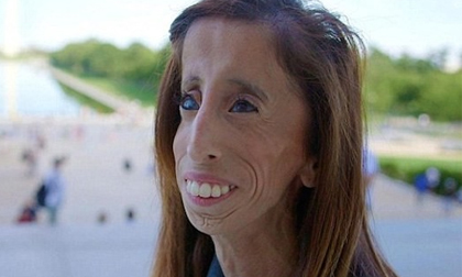 Cô gái xấu nhất thế giới thành người truyền cảm hứng