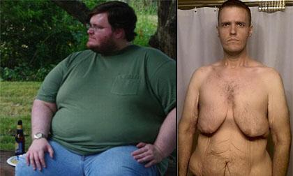 Chàng trai béo phì lộ da thừa 'kinh dị' sau khi giảm 160kg