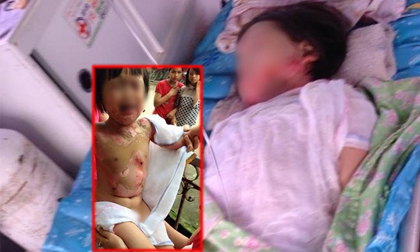 Xót xa bé gái bị bạn đốt bỏng nửa người ở trường mầm non