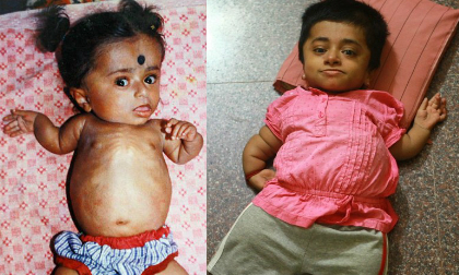Cô gái mắc bệnh lạ 19 tuổi vẫn như trẻ lên 2