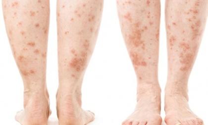 4 bệnh ngoài da cảnh báo thêm các vấn đề sức khỏe