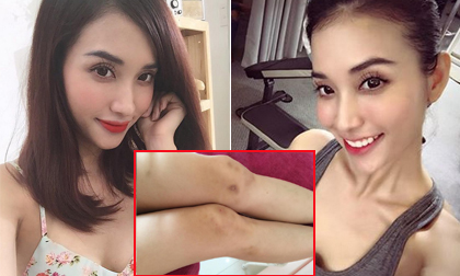 Mai Hồ tiết lộ đôi chân bầm tím vì đóng phim