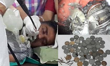 'Sởn da gà' trước chàng trai nuốt tiền xu và hàng trăm chiếc đinh