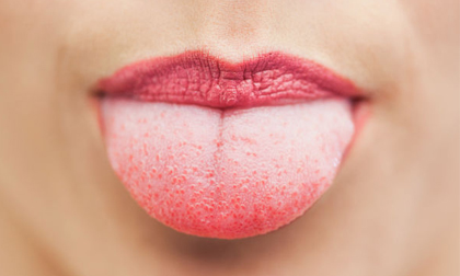 Màu sắc của lưỡi tiết lộ gì về sức khỏe?