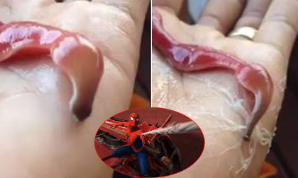 Ấu trùng 'nhả tơ' như 'Spiderman' gây xôn xao