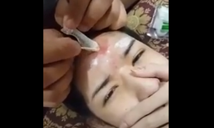 Cận cảnh màn phẫu thuật tiêm chất độn mặt vào… hộp sọ