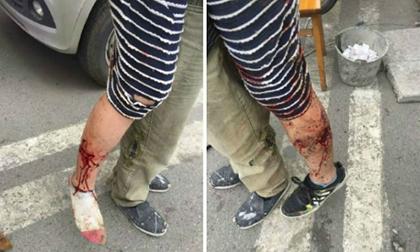 Người mẹ dũng cảm xả thân ôm con mặc chó cắn khắp người