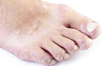 Biểu hiện của bàn chân 'tố cáo' tình hình sức khỏe của bạn